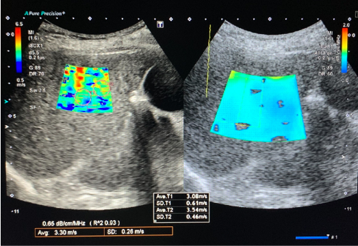 脂肪肝の症例　SWE（左画面）・ATI（右画面）